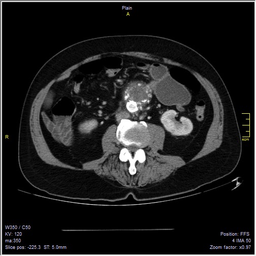Abdominal aortic aneurysm with thrombus fissuration (Radiopaedia 47340-51926 Axial C+ arterial phase 34).jpg