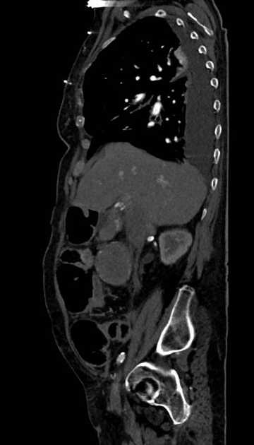 Abdominal aortic aneurysm with thrombus fissuration (Radiopaedia 73192-83919 Sagittal C+ arterial phase 100).jpg