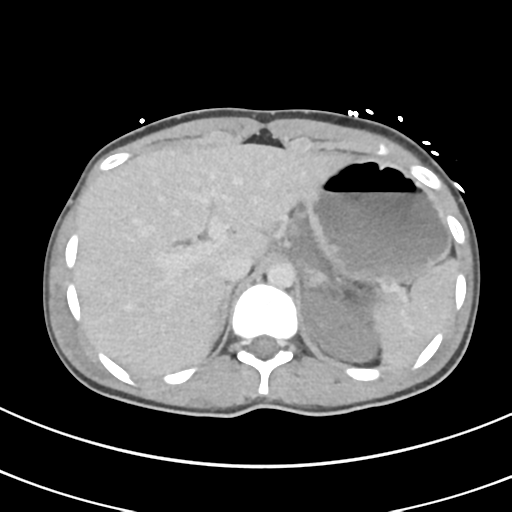 File:Abdominal multi-trauma - devascularised kidney and liver, spleen and pancreatic lacerations (Radiopaedia 34984-36486 Axial C+ delayed 16).png