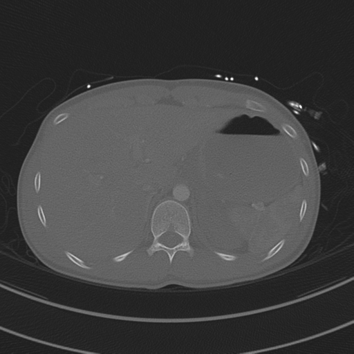File:Abdominal multi-trauma - devascularised kidney and liver, spleen and pancreatic lacerations (Radiopaedia 34984-36486 I 83).png