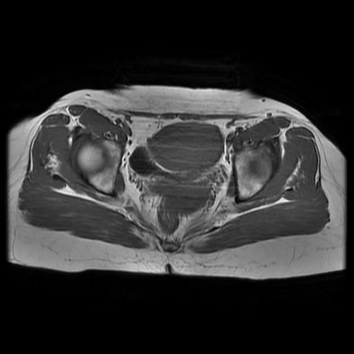 File:Abdominal wall endometriosis (Radiopaedia 83702-98847 Axial T1 12).jpg