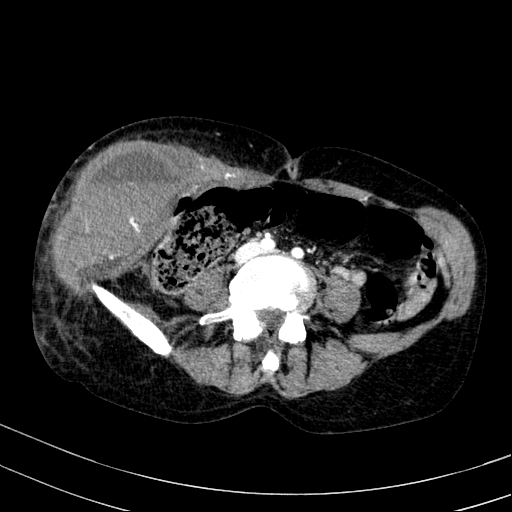 Abdominal wall hematoma with active bleeding (Radiopaedia 83915-99117 Axial renal cortical phase 70).jpg