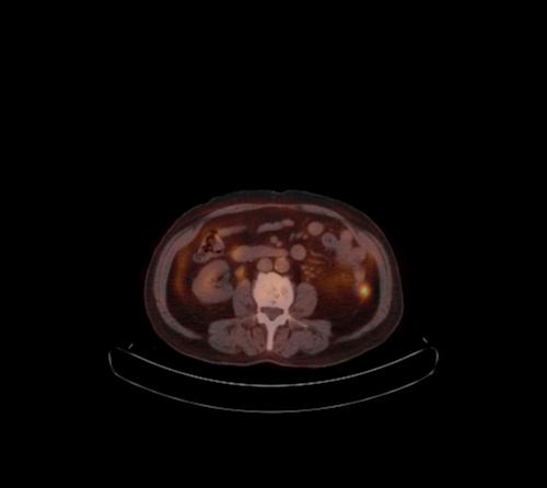 Abdominal wall metastasis from colorectal carcinoma (Radiopaedia 31016-31719 C 61).jpg