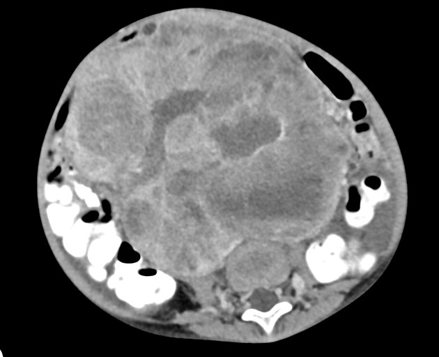 Abdominopelvic rhabdomyosarcoma (Radiopaedia 78356-90984 Axial C+ portal venous phase 104).jpg