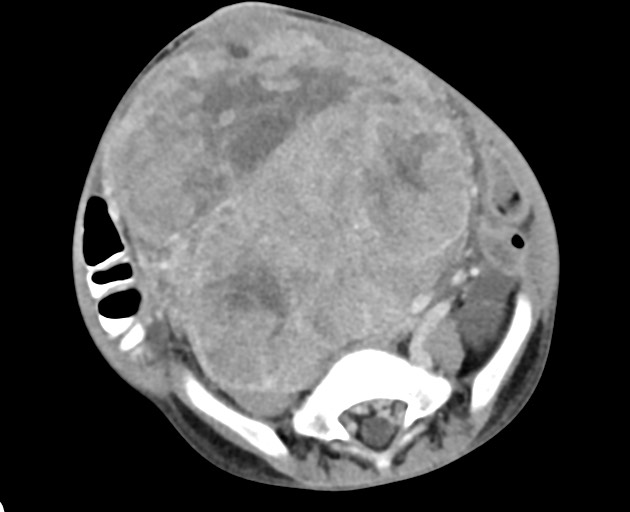 Abdominopelvic rhabdomyosarcoma (Radiopaedia 78356-90984 Axial C+ portal venous phase 116).jpg