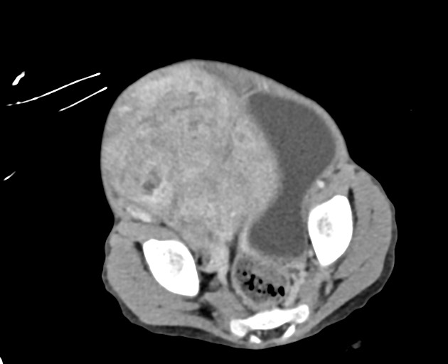 Abdominopelvic rhabdomyosarcoma (Radiopaedia 78356-90984 Axial C+ portal venous phase 137).jpg