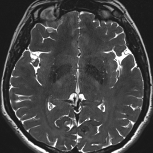 Abducens nerve palsy (Radiopaedia 51069-56648 Axial T2 fat sat 92).png