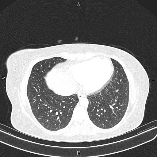 File:Aberrant right subclavian artery (Radiopaedia 87334-103629 Axial lung window 48).jpg
