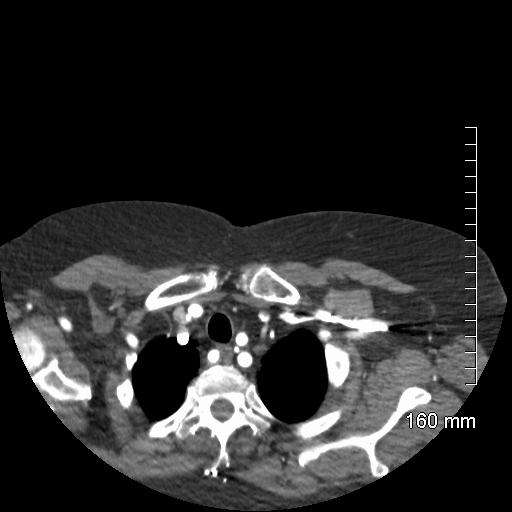 Aberrant right subclavian artery stenosis (Radiopaedia 52656-58670 Axial C+ arterial phase 11).jpg