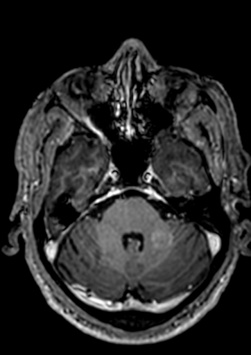Accessory middle cerebral artery (Radiopaedia 73114-83828 Axial T1 C+ 118).jpg