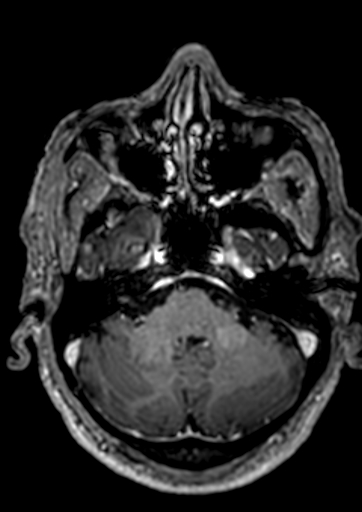 Accessory middle cerebral artery (Radiopaedia 73114-83828 Axial T1 C+ 129).jpg