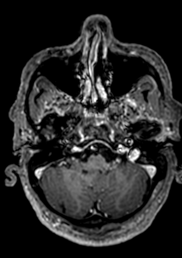 Accessory middle cerebral artery (Radiopaedia 73114-83828 Axial T1 C+ 146).jpg