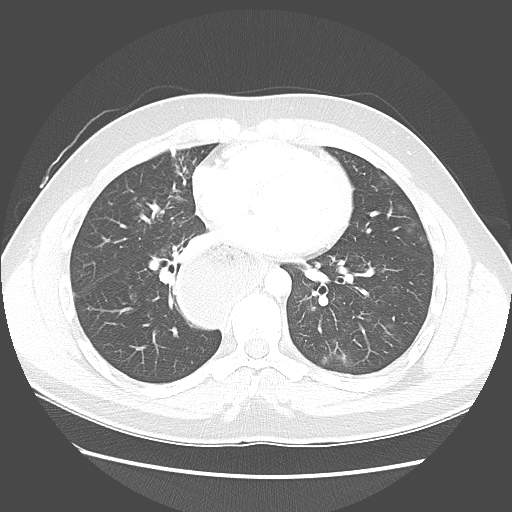 Achalasia (Radiopaedia 52507-58417 Axial lung window 38).jpg