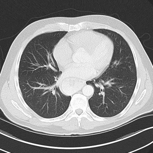 Achalasia of the cardia (Radiopaedia 38497-40595 Axial lung window 32).png