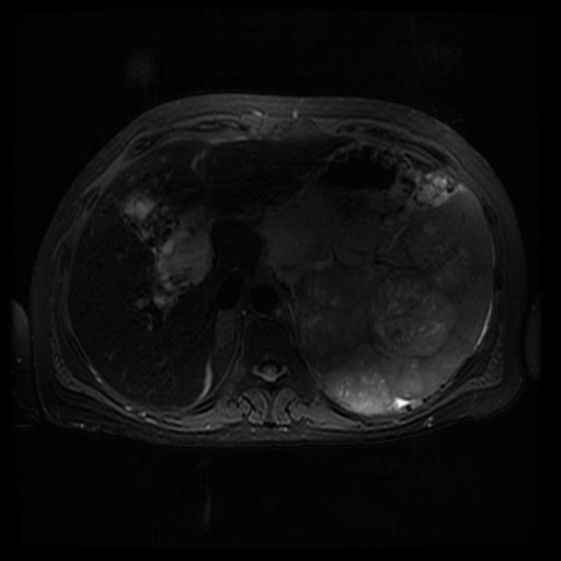 File:Acinar cell carcinoma of the pancreas (Radiopaedia 75442-86668 Axial T2 fat sat 24).jpg