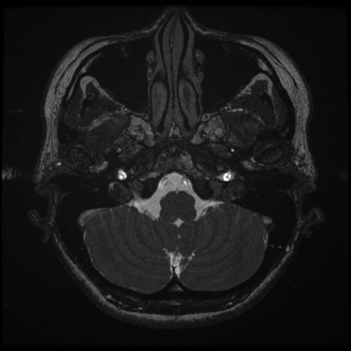 Acoustic neuroma (Radiopaedia 34049-35283 Axial 24).png