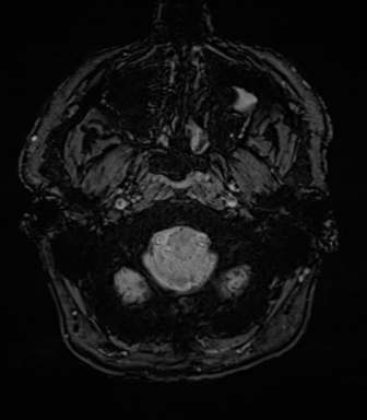 Acoustic schwannoma (Radiopaedia 50846-56358 Axial SWI 8).png