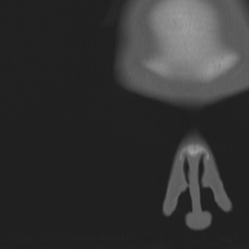 Acoustic schwannoma - eroding petrous apex (Radiopaedia 39674-42002 Coronal bone window 2).png