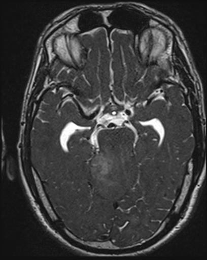 File:Acoustic schwannoma - probable (Radiopaedia 20386-20292 Axial T1 58).jpg