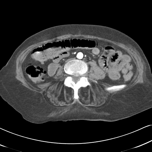 File:Active bleeding from duodenal ulcer with embolization (Radiopaedia 34216-35481 Axial C+ arterial phase 36).png