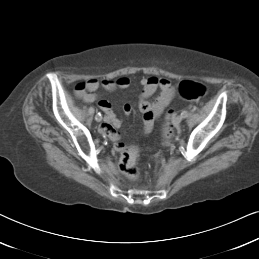 Active bleeding from duodenal ulcer with embolization (Radiopaedia 34216-35481 Axial non-contrast 54).png