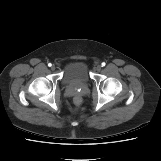 Active colonic bleed on CT (Radiopaedia 49765-55025 Axial C+ arterial phase 80).jpg