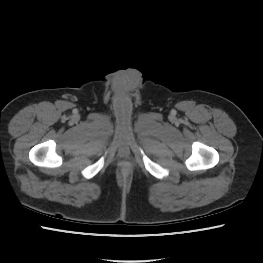 File:Active colonic bleed on CT (Radiopaedia 49765-55025 Axial C+ delayed 91).jpg