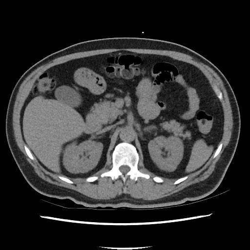 Active colonic bleed on CT (Radiopaedia 49765-55025 Axial non-contrast 26).jpg