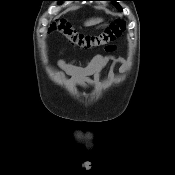 Active colonic bleed on CT (Radiopaedia 49765-55025 Coronal non-contrast 10).jpg