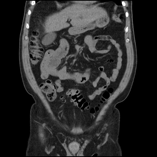Active colonic bleed on CT (Radiopaedia 49765-55025 Coronal non-contrast 18).jpg