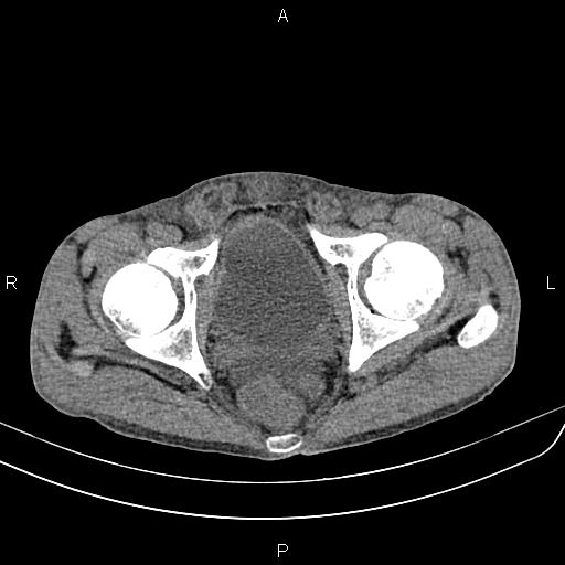 Active crohn disease (Radiopaedia 87133-103397 Axial non-contrast 97).jpg