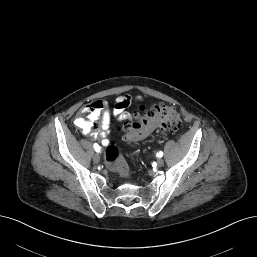 File:Active lower gastrointestinal bleeding - diverticular (Radiopaedia 61203-69106 Axial C+ arterial phase 41).jpg
