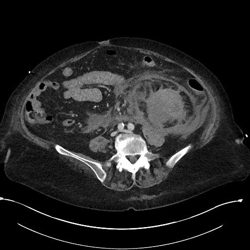 File:Active renal extravasation with large subcapsular and retroperitoneal hemorrhage (Radiopaedia 60975-68796 Axial 234).jpg