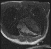Active right ventricular cardiac sarcoidosis (Radiopaedia 55596-62100 Axial Dynamic perfusion scan MOCO 36).jpg