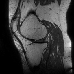 Acute-on-chronic transient lateral patellar dislocation with trochlear dysplasia (Radiopaedia 84099-99349 Sagittal PD 109).jpg