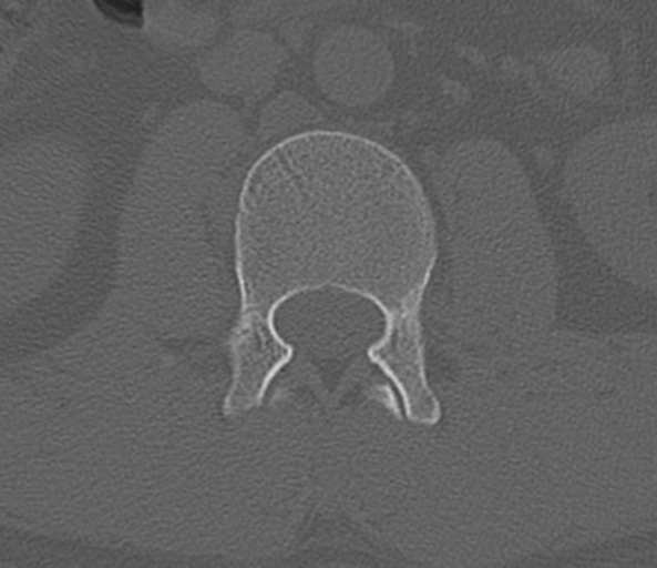 File:Acute L1 burst compression fracture (Radiopaedia 34430-35755 Axial bone window 32).png
