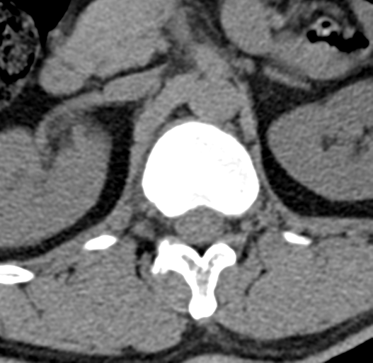 File:Acute L1 burst compression fracture (Radiopaedia 34430-35755 Axial non-contrast 16).png