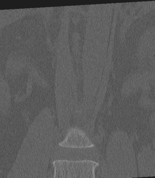 File:Acute L1 burst compression fracture (Radiopaedia 34430-35755 Coronal bone window 10).png