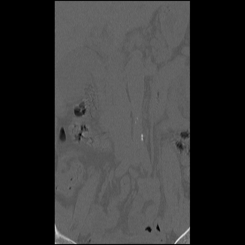Acute Schmorl's node (Radiopaedia 83276-102365 Coronal bone window 9).jpg