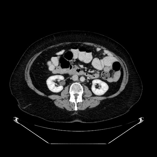 File:Acute appendicitis, heterotaxy syndrome (Radiopaedia 66884-76202 Axial 31).jpg