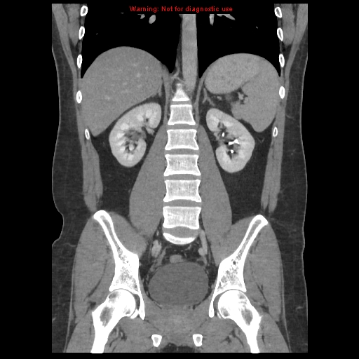 File:Acute appendicitis (Radiopaedia 10498-10973 F 30).jpg