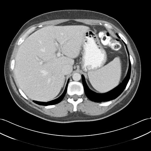 Acute appendicitis (Radiopaedia 30297-30934 Axial C+ portal venous phase 16).jpg