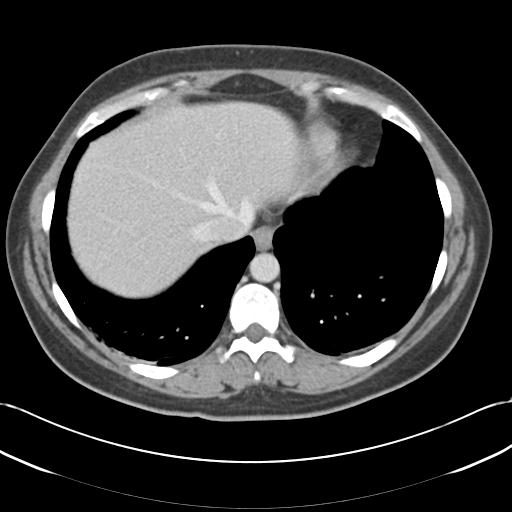 File:Acute appendicitis (Radiopaedia 30297-30934 Axial C+ portal venous phase 9).jpg