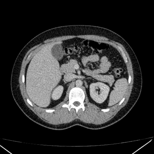 Acute appendicitis (Radiopaedia 38255-40270 Axial C+ portal venous phase 33).jpg
