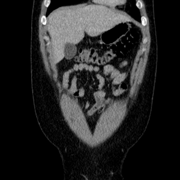 File:Acute appendicitis (Radiopaedia 38255-40270 Coronal C+ portal venous phase 20).jpg