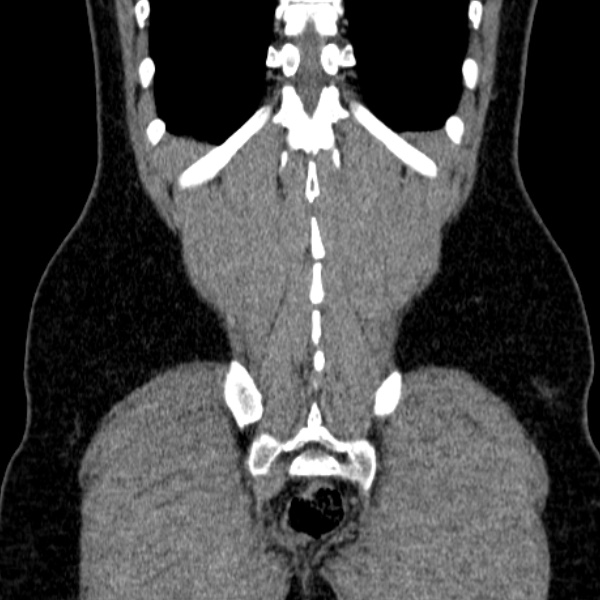 File:Acute appendicitis (Radiopaedia 38255-40270 Coronal C+ portal venous phase 75).jpg