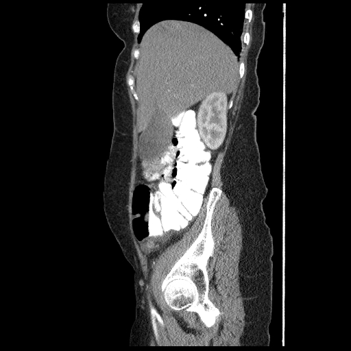 File:Acute appendicitis (Radiopaedia 52672-58589 Sagittal C+ arterial phase 27).jpg