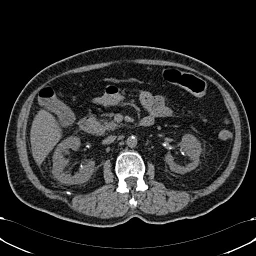 Acute appendicitis (Radiopaedia 58627-65818 Axial non-contrast 37).jpg