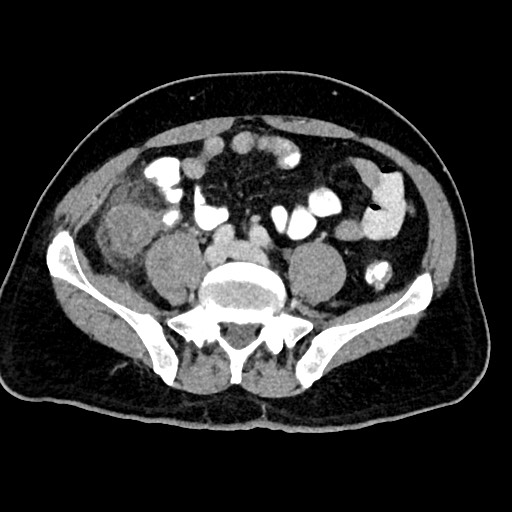 Acute appendicitis (Radiopaedia 77016-88960 Axial C+ portal venous phase 97).jpg