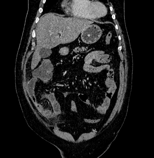 Acute appendicitis (Radiopaedia 79950-93224 Coronal C+ portal venous phase 25).jpg